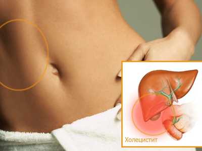 Лечение холецистита